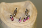 Figure 13  Highly divergent implants/impression copings with the corresponding custom tray. Note the slightly larger access holes to compensate for divergence.