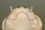 Figure 15  The maxillary verified master cast with plastic temporary copings, replica (to intraoral) healing abutments placed, and desired extensions outlined.