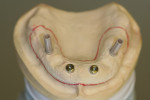 Figure 16  The maxillary verified master cast with plastic temporary copings, replica (to intraoral) healing abutments placed, and desired extensions outlined.