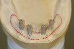 Figure 19  The mandibular verified master cast with four temporary copings placed and desired extensions outlined. The outline represents the 