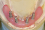 Figure 20  A wax shim (1 mm) is placed as a relief to obtain a basebar that sits off the tissue as expected in the final prosthesis.