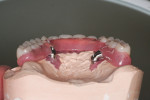 Figure 37  The finished mandibular SR hybrid denture with two palatal Branemark 42.5-mm zygomatic implants. Note: Because of the palatal position of the implants, the bar had to extend out of the arch form/body of the device to interface with the imp