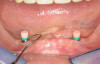 Figure 4   Illustrations demonstrating Class II veneer preparations requiring a modified design. Facial reduction should be less than 0.5 mm, 80% to 95% of the enamel should remain, and 10% to 20% of the dentin can be exposed. (Brown in illustration is exposed dentin.) .