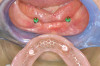Figure 7  Close-up occlusal view of the Class II veneer preparation with a minimal intervention to modified preparation design.