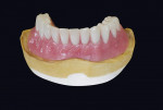 Figure 14  The finished implant overdenture.