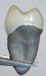 Figure 1  The CAM-manufactured patient-specific titanium implant root fixture and implant abutment with glass–ceramic temporary crown.