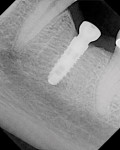 Figure 7  An x-ray showing the bone completely integrated with the implant and the tissue response.