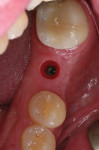 Figure 8  Implant site 3 months later with the tissue former removed. The tissue has grown back to previous levels.