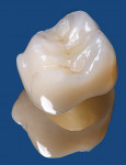 Figure 13  Full-contour crown milled from the Lava Ultimate nano-ceramic material.