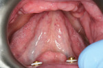 Figure 3  The mandibular denture was retained with two locators.