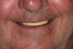 Figure 6  The pre-fabricated occlusal rim used in the maxilla from Schutz Dental comes in contrasting colors.
