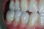 Figure 13  The patient’s right side showed the new and improved occlusal scheme. (Note the buccal cusps act as the 