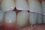 Figure 15  The anterior teeth were set in almost an end-to-end fashion, where the anteriors just touch.