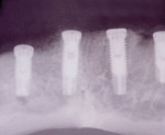 Figure 3  Panorex of the four implants placed in the mandible.
