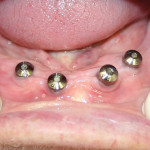 Figure 6  Healing abutments were placed on each of the four implants.