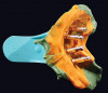 Figure 7  Completion of maxillary orthodontic treatment created adequate space for implants at site Nos. 7 and 10. The retained right primary maxillary canine was extracted and orthodontic movement was performed to translate the right permanent canine into the No. 6 position, creating room for a No. 7 implant, and generally align the teeth.