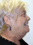 Figure 18  Profile view of the patient with the final denture in place.