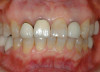 Figure 1  In Case 1, the patient’s edentulous site appeared healthy, with significant keratinized mucosa in the canine position.