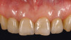 Figure 5  Small portion of rhBMP-2-seeded ACS was placed over the buccal portion of the mesh to contain FDBA particles.
