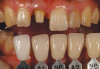 Figure 7  3-D radiographic evaluation showed a gain of about 4 mm in the thinnest area of ridge width.