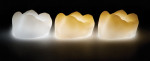 Figure 1  High translucency and sintered Zirlux FC crowns prior to staining.