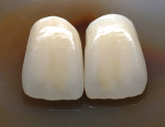 Figure 3  Ceramics2in1 porcelain was applied to both the titanium (left) and the zirconium (right) coping.