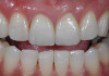 Figure 2  Ideal master model with excellent detail of prepared teeth, as well as occlusal surfaces of unprepared teeth.
