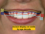 Figure 6  The gumminess of the smile decreases with age. This illustration demonstrates the proposed changes by the decade.