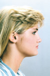 Figure 11  At age 14 and completion of full appliance therapy, the patient’s facial changes were dramatic. A balanced profile with excellent lip support was achieved.