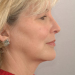 Figure 18  The profile reflects the nasal and chin neck changes best, with a greater chin neck length in the lower face and raised nasal tip and refined dorsum in the upper face.