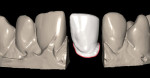 Figure 6  The facial view of the zirconia coping.