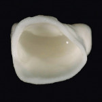 Figure 15  Corrective porcelain powder was applied to the coping and the interior of the veneer.