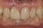Figure 21  The final restoration exhibits an outstanding match to the left central incisor and surrounding dentition.