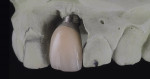 Figure 10  A highly esthetic temporary was created using New-Outline from Anaxdent.