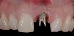 Figure 12  The tissue was contoured to the ideal highly polished Gradia custom abutment. The margin was in its ideal proposed place from the model.