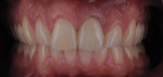 Figure 14  The temporary after 1 week. The patient now had a better visual idea of the final outcome.