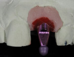 Figure 16  The ideal sulcus from the model the temporary was fabricated from was used to pick up an accurate impression. This was achieved by placing GC pattern resin in the sulcus of the soft tissue with the impression coping in place. This impressi