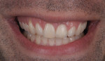 Figure 31  Try-in of the final crown at full smile.