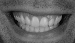 Figure 32  A value check is extremely important when restoring one tooth to see that there is no discrepancy with the surrounding dentition.