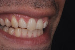 Figure 35  After wearing the crown for a week, the patient observed from different angles that he wanted a small addition to the mesial aspect of the restoration.