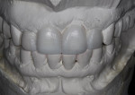Figure 4  A diagnostic wax-up was fabricated. The patient reviewed the wax-up and provided feedback on tooth form, shape, and position.