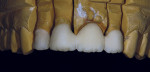 Figure 22  The units were placed back on the model, checked with the matrix, and any necessary contouring was done in preparation for porcelain layering.