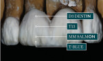 Figure 24  The first porcelain buildup was performed with D3 Dentin, Mammalon (Salmon), Ti3, and Transpa blue.