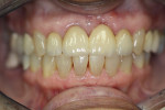 Figure 27  The restorations a week postoperative. The small gingival defect can be seen, as well as the patient’s low smile line. The shade match to the lower anteriors and the blending with the upper cupsids were regarded by the patient, dentist,