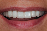 Figure 19  The patient’s final smile several weeks after placement.