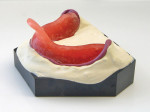 Figure 1  A type III hard stone model is made from the impression of the edentulous ridge.