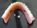 Figure 10   The rinsed and dried denture.
