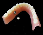 Figure 11  The finished upper and lower dentures with the installed Ultra Suction<sup>™</sup> valves.
