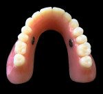 Figure 12  The finished upper and lower dentures with the installed Ultra Suction<sup>™</sup> valves.