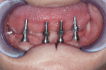 Figure 3  The implant impression copings were placed for master-cast fabrication.